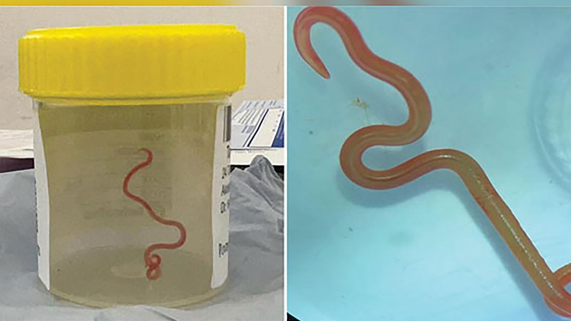Australien, Canberra: Ein lebender Spulwurm "Ophidascaris robertsi" in einem Becher, der im Gehirn einer 64-jährigen Australierin gefunden wurde. Australien, Canberra: Ein lebender Spulwurm "Ophidascaris robertsi" in einem Becher, der im Gehirn einer 64-jährigen Australierin gefunden wurde.