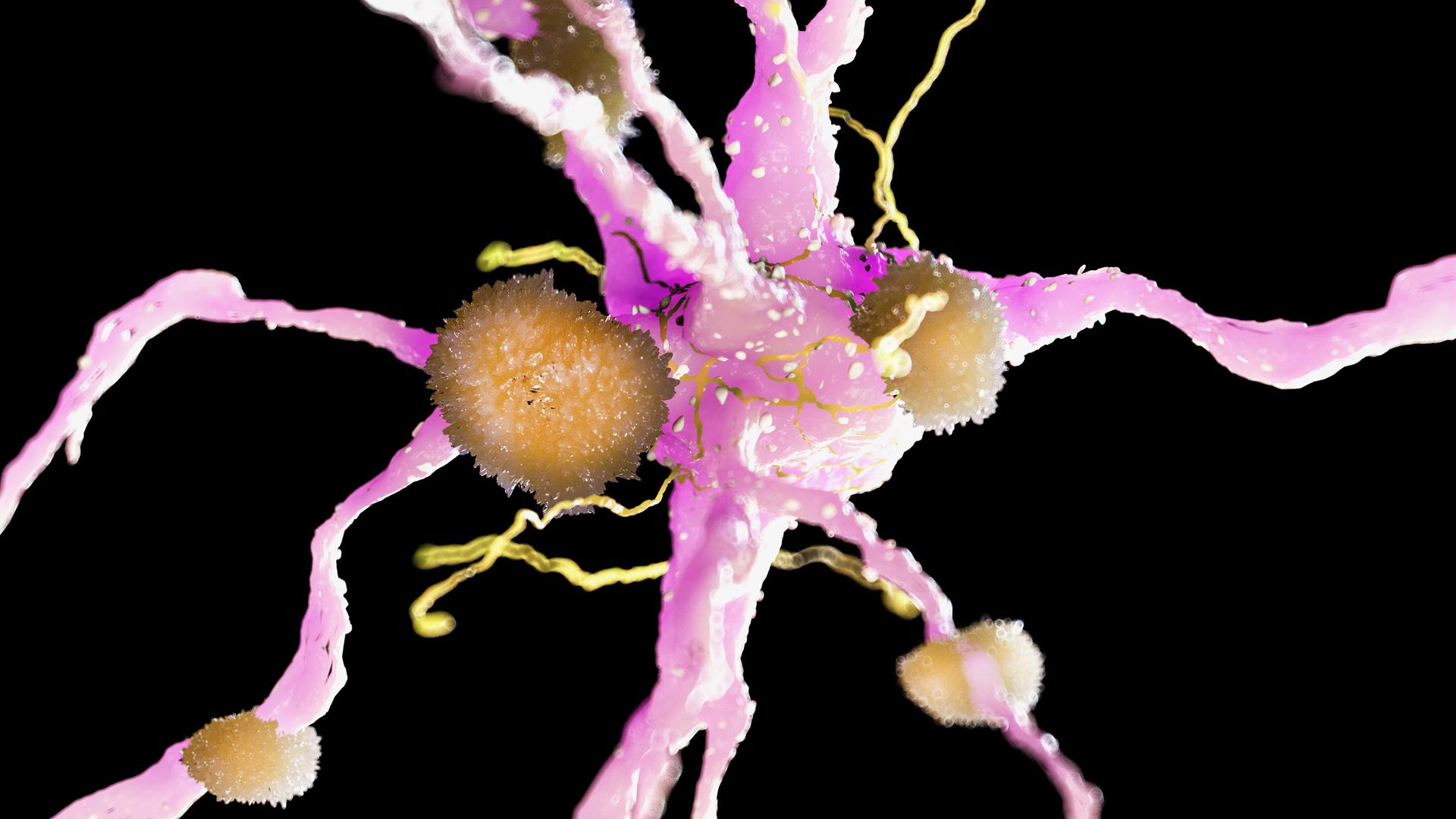 3D-Illustration von Amyloid-Ablagerungen auf einer Nervenzelle