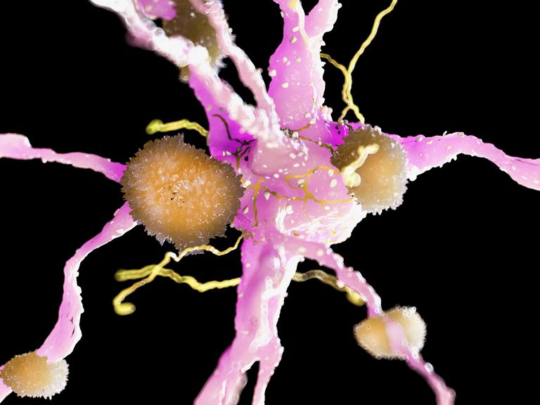 3D-Illustration von Amyloid-Ablagerungen auf einer Nervenzelle