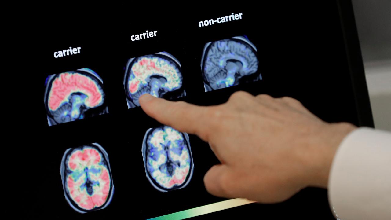Ein ausgestreckter Zeigefinger deutet auf einen PET-Gehirnscan. 