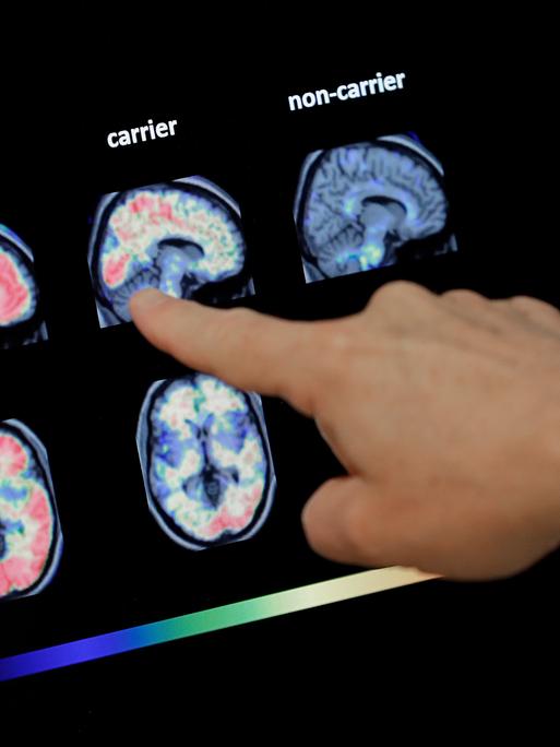 Dr. William Burke begutachtet einen PET-Gehirnscan im Banner Alzheimers Institute in Phoenix. 