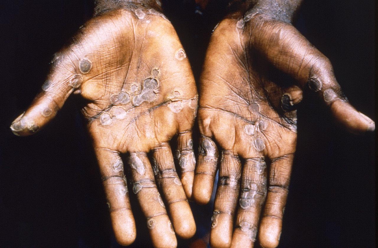 Das Bild aus dem Jahr 1997 entstand während einer Untersuchung eines Ausbruchs von Mpox in der Demokratischen Republik Kongo und zeigt die Handflächen eines Patienten mit einem Mpox-Fall.