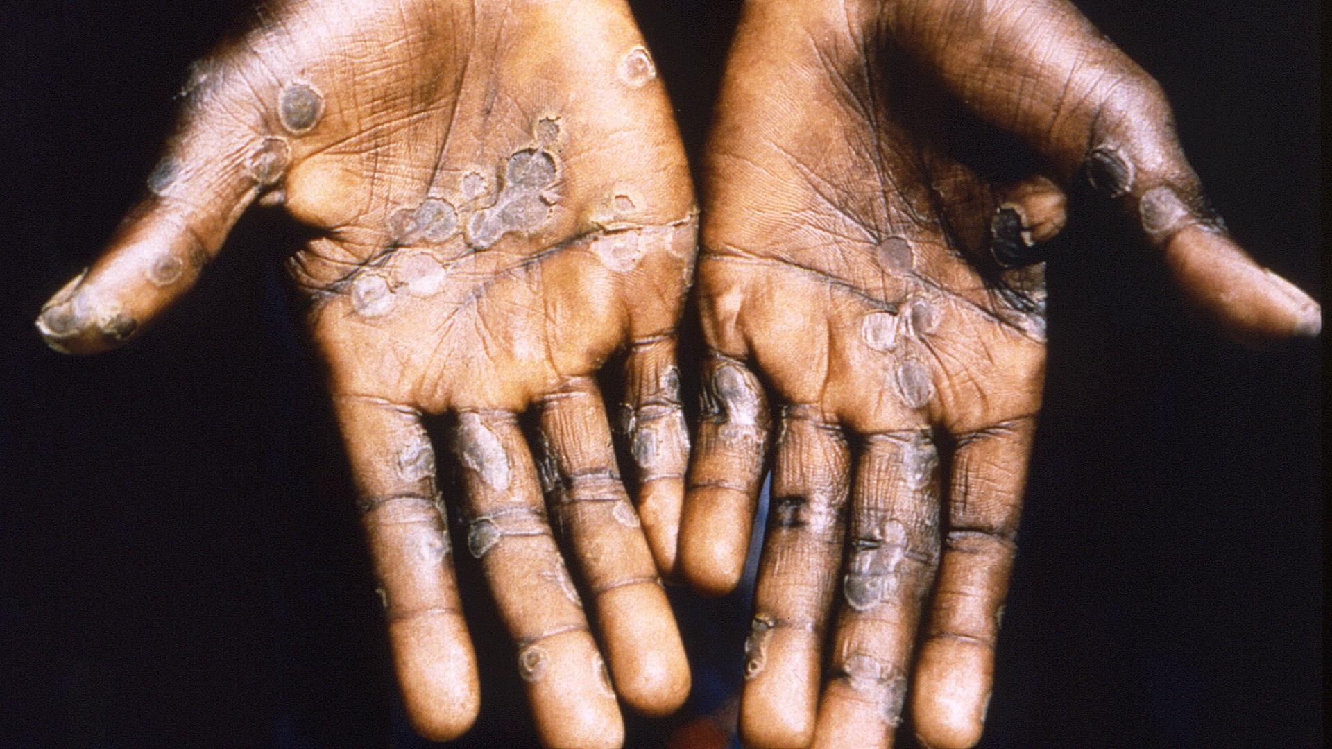 Das Bild aus dem Jahr 1997 entstand während einer Untersuchung eines Ausbruchs von Mpox in der Demokratischen Republik Kongo und zeigt die Handflächen eines Patienten mit einem Mpox-Fall.