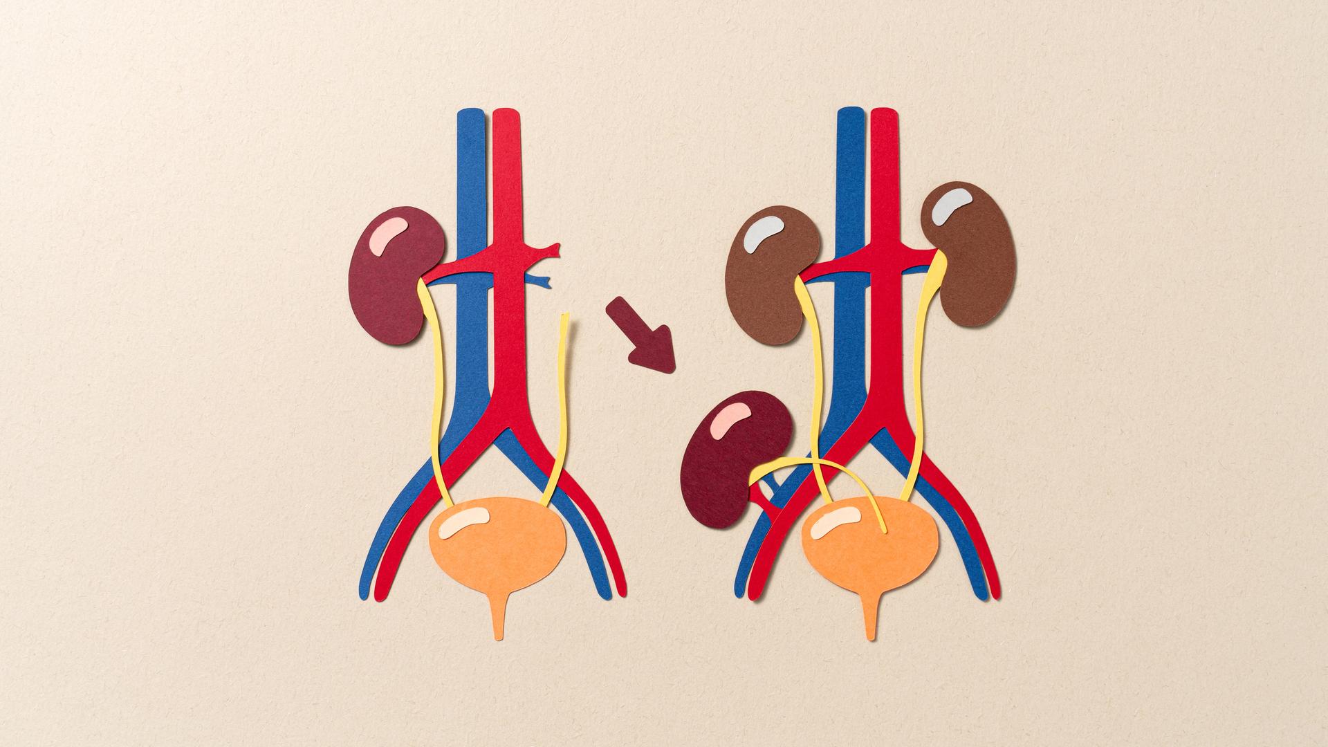Illustrative Darstellung einer Nierentransplantation.