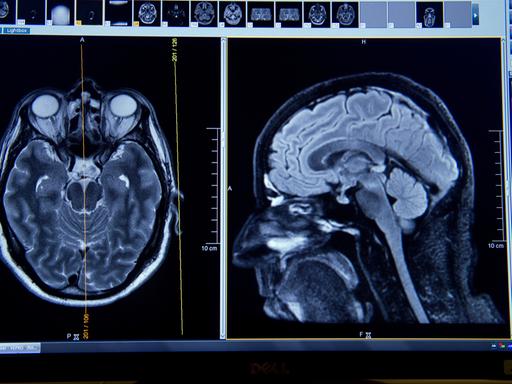 Auf dem Display eines Magnetresonanztomographen sind am 10.07.2015 Schichtaufnahmen eines Gehirns erkennbar