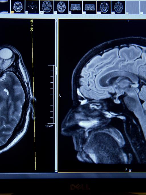 Auf dem Display eines Magnetresonanztomographen sind am 10.07.2015 Schichtaufnahmen eines Gehirns erkennbar