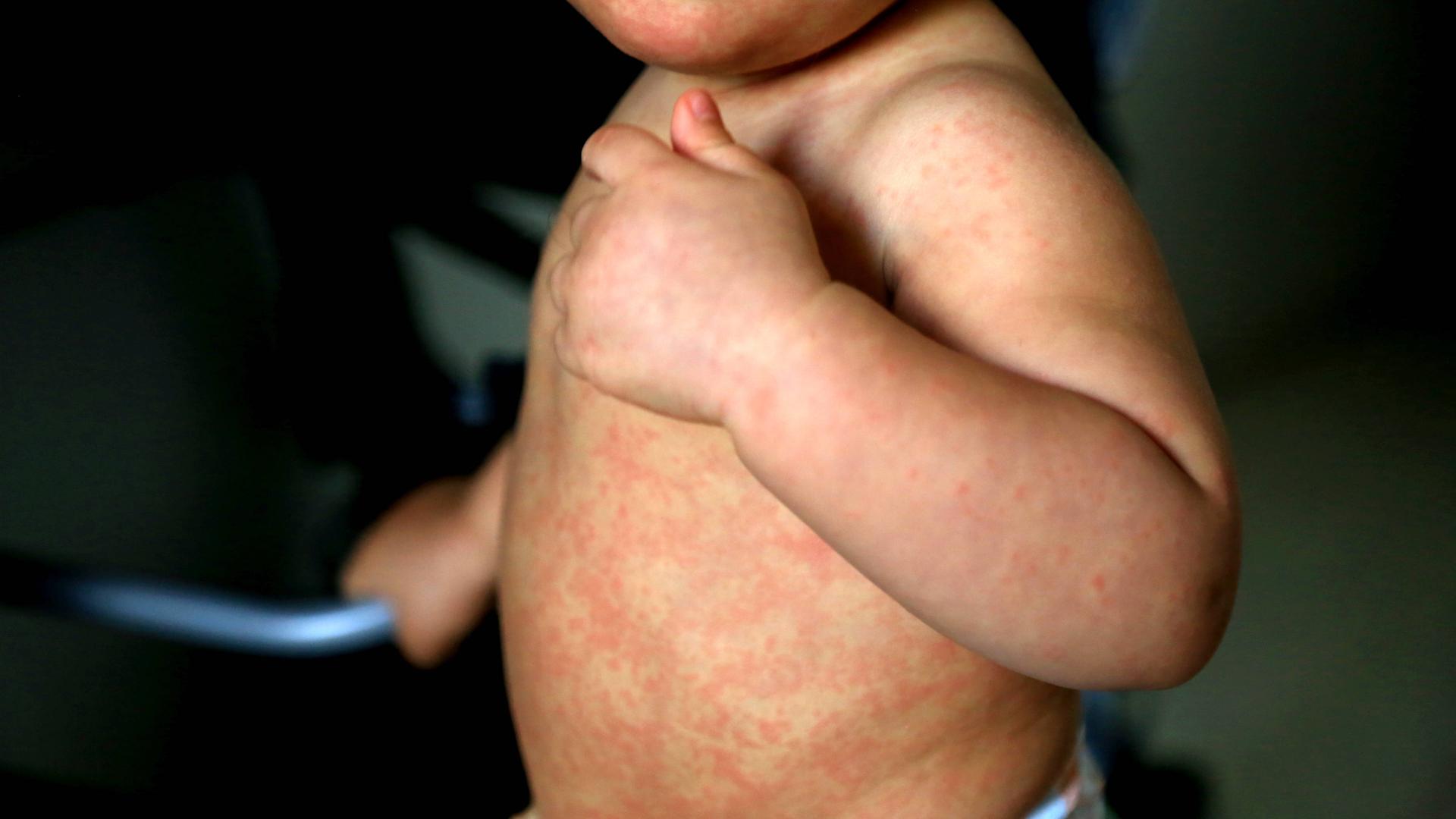 Ein kleines Kind mit roten Flecken auf Bauch und Armen. Ein kleines Kind mit roten Flecken auf Bauch und Armen.