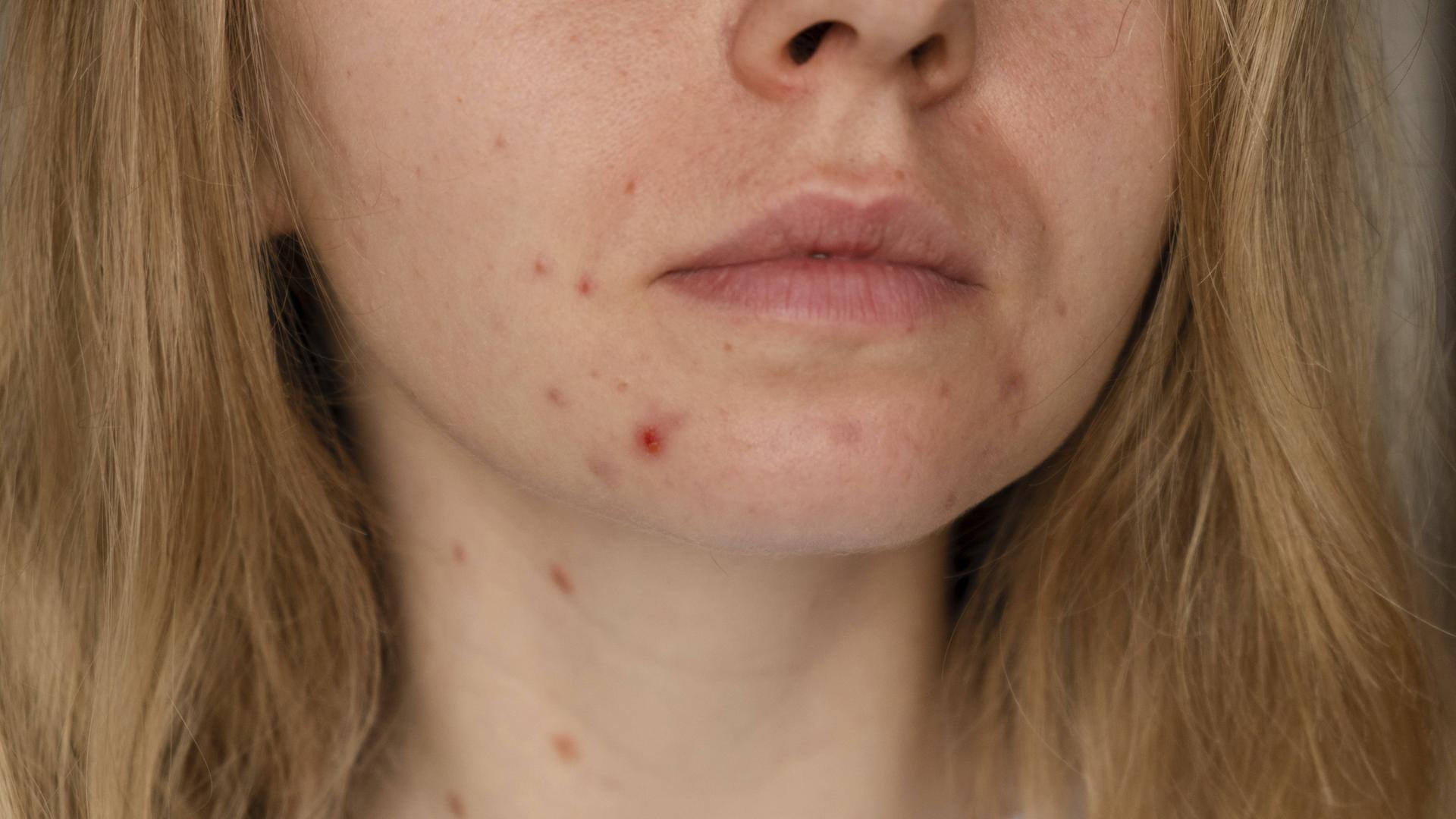 Eine unerkennbare Frau zeigt ihre Akne im Gesicht. Eine unerkennbare Frau zeigt ihre Akne im Gesicht.
