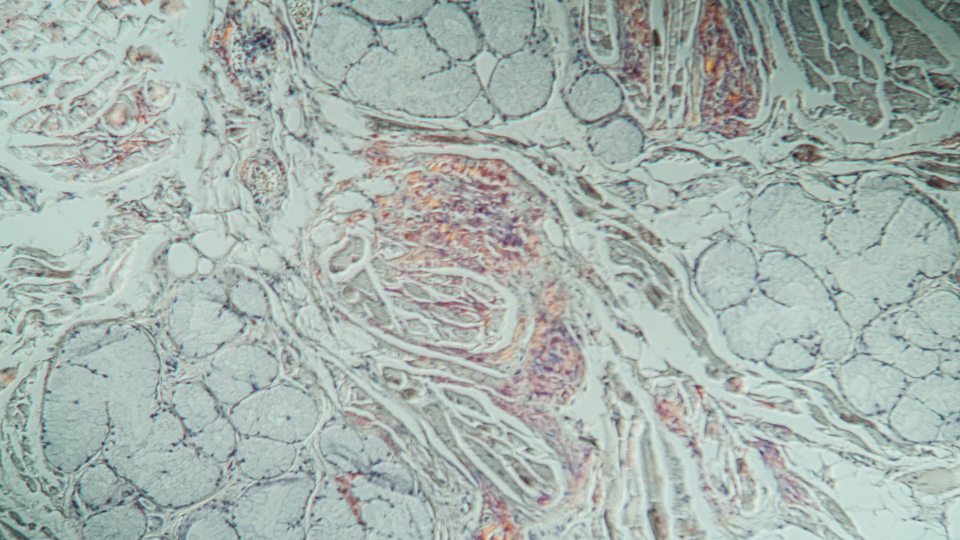 Protein-Ablagerungen in krankem HirnGewebe unter dem Mikroskop.