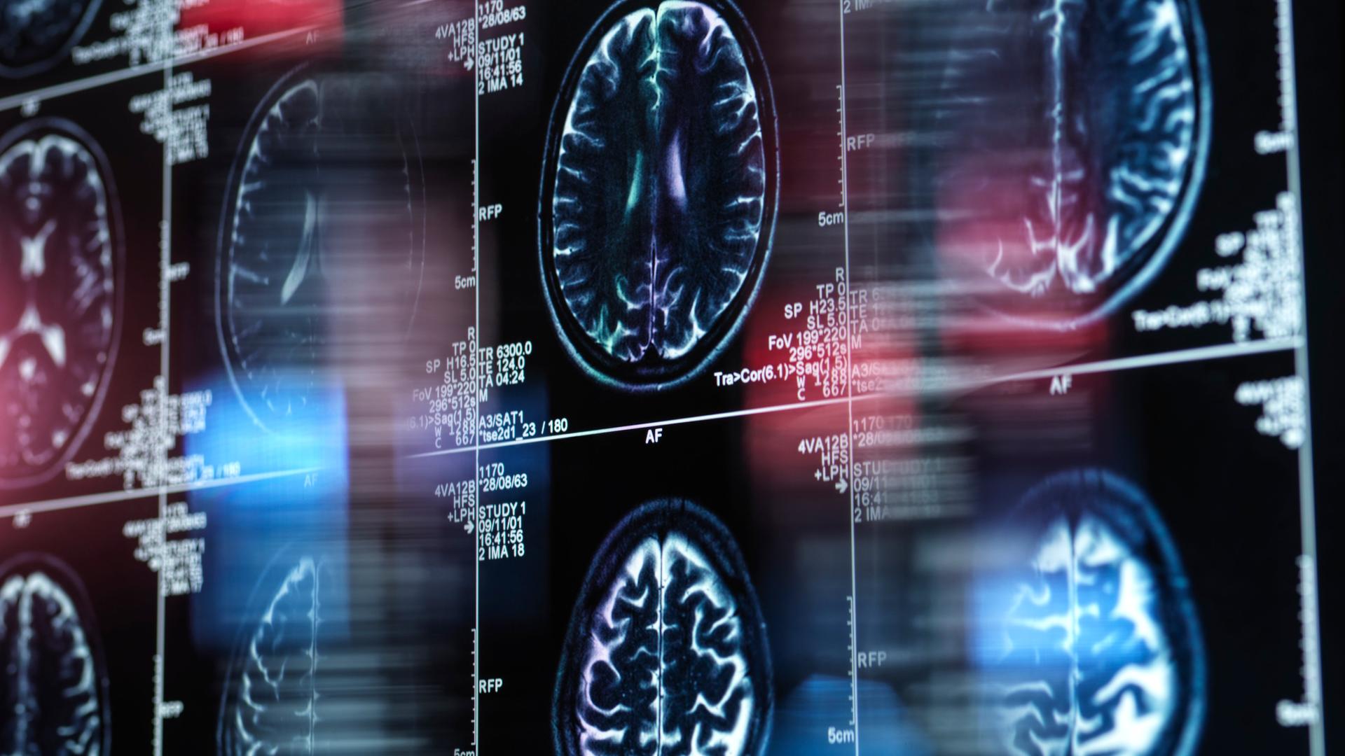 MRT-Scan eines menschlichen Gehirns auf einem Bildschirm.