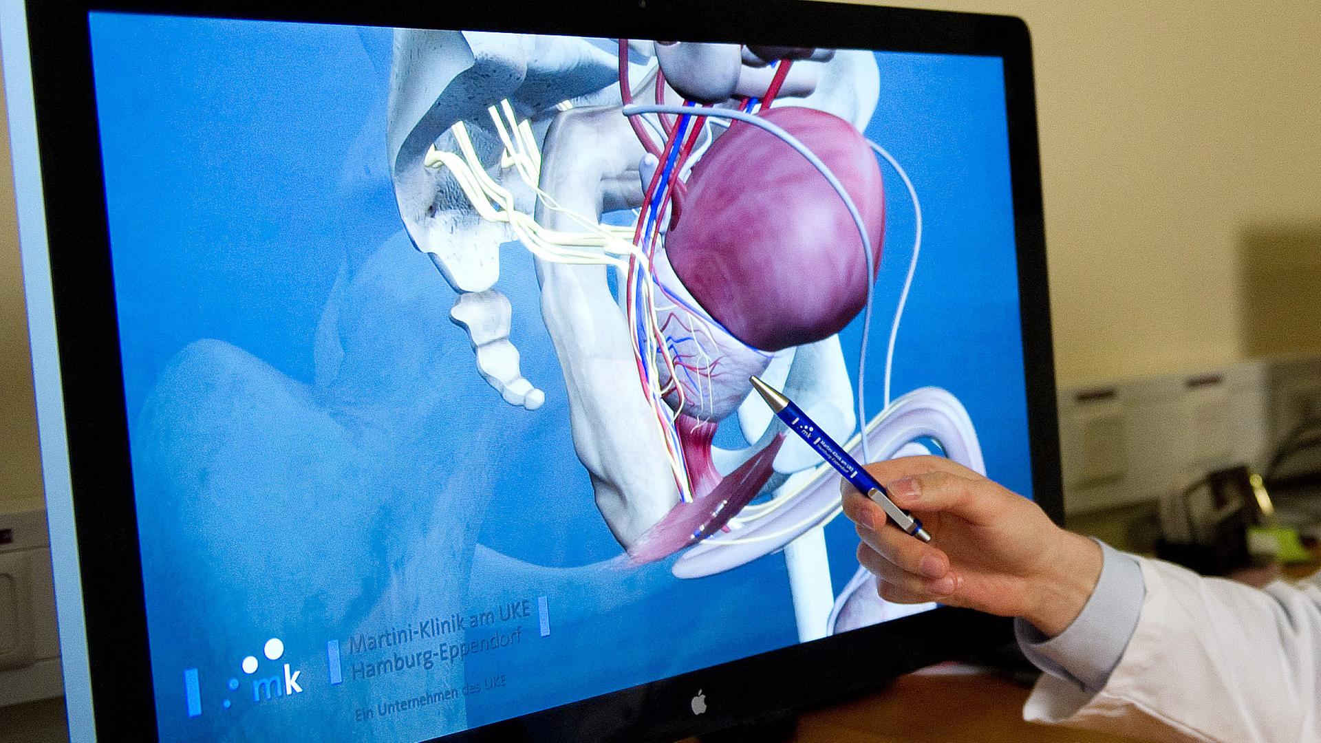 Ein Computerbildschirm zeigt eine 3D-Darstellung einer Prostata.