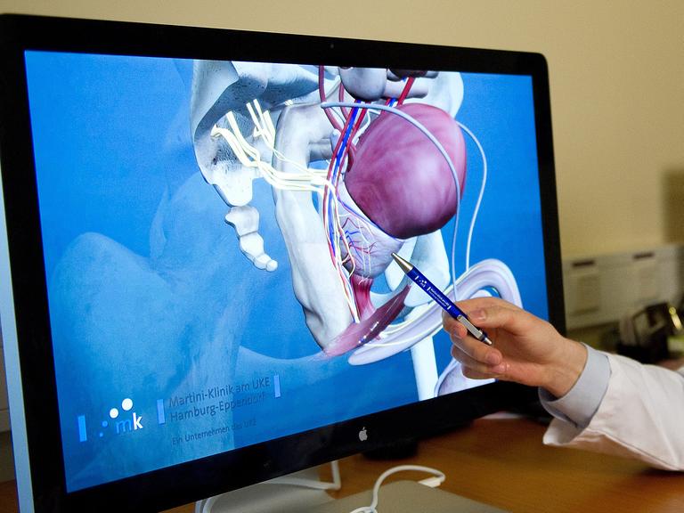 Ein Computerbildschirm zeigt eine 3D-Darstellung einer Prostata.