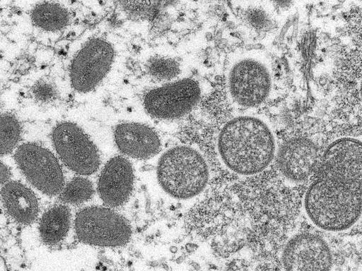 Die elektronenmikroskopische Aufnahme von den Centers for Disease Control and Prevention aus dem Jahr 2003 zeigt reife, ovale Affenpocken-Viren und kugelförmige unreife Virionen aus einer menschlichen Hautprobe. 