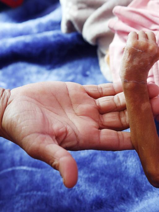 Die Hand eines Erwachsenen hält den unternährten Arm eines Kindes im Jemen in der Hand. Millionen Menschen sind von Hunger bedroht. 