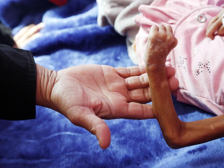 Die Hand eines Erwachsenen hält den unternährten Arm eines Kindes im Jemen in der Hand. Millionen Menschen sind von Hunger bedroht. 