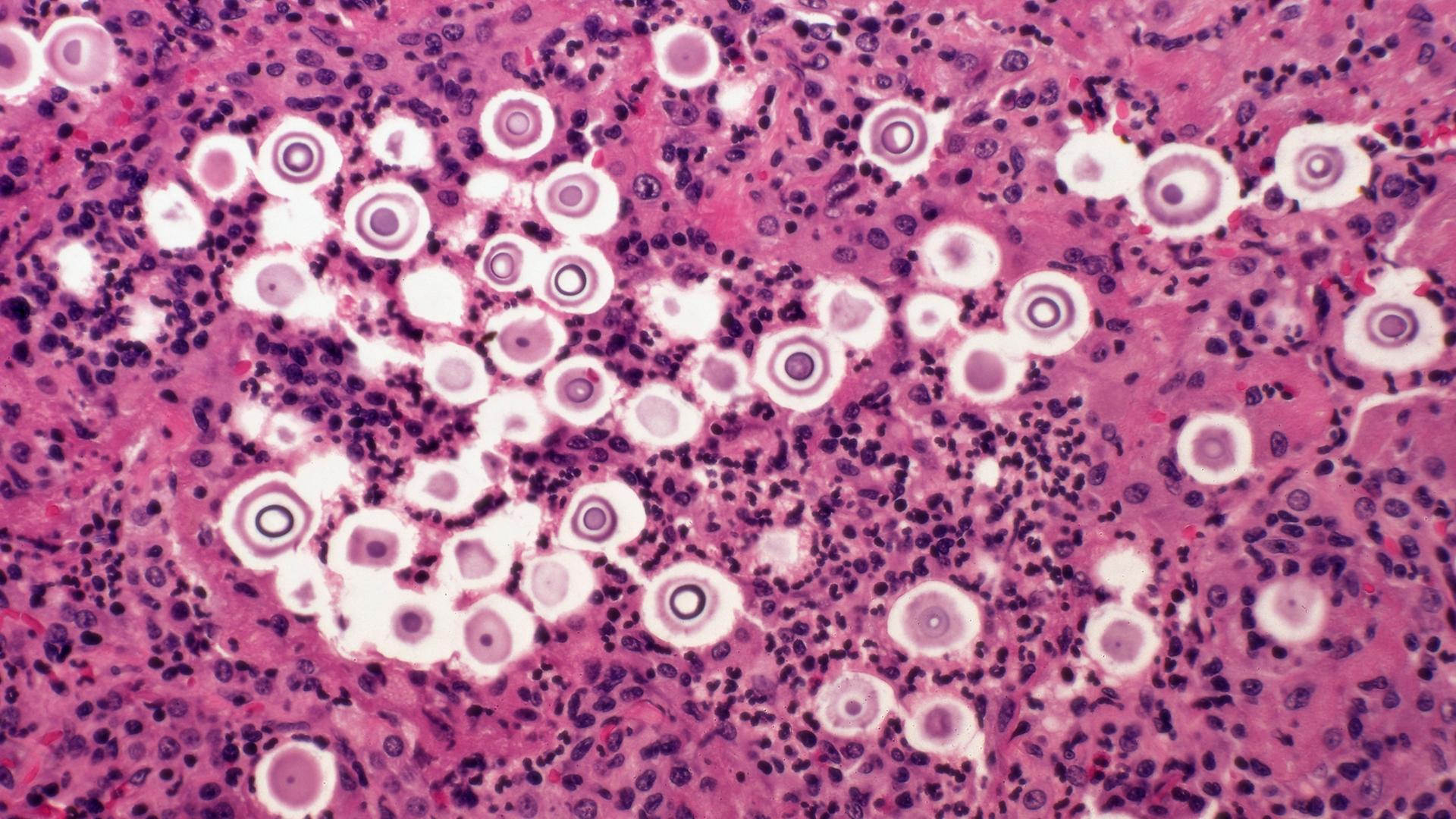 Vergößerte Aufnahme: Pilzinfektion der Lunge mit Cryptococcus neoformans.