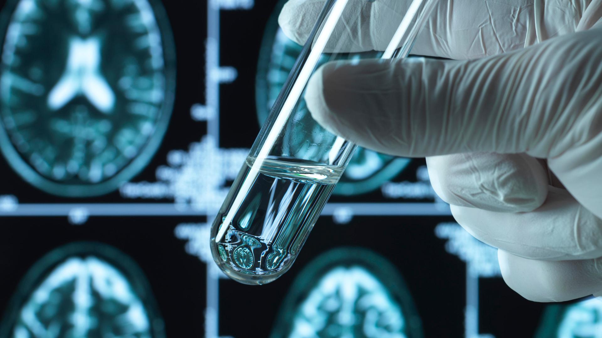 Ein Reagenzglas mit Flüssigkeit darin. Im Hintergrund: Aufnahmen eines menschlichen Gehirns, angefertigt mithilfe von bildgebenden Verfahren. 