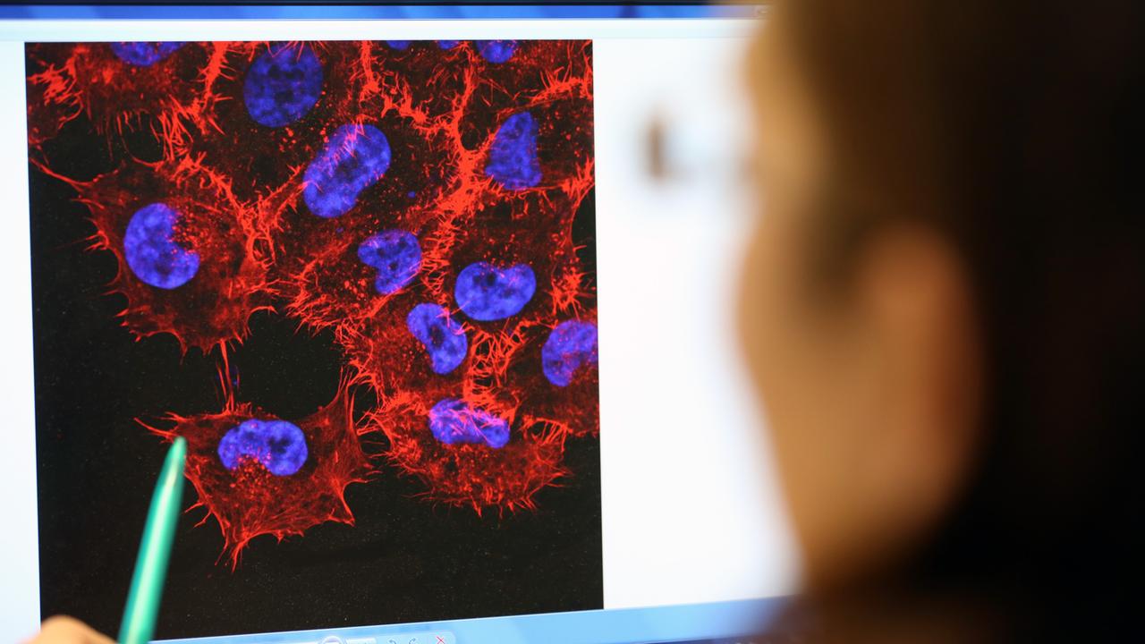 Im Labor des Instituts für Experimentelle Gentherapie und Tumorforschung (IEGT) der Universitätsmedizin Rostock schaut eine Doktorandin auf ein Monitorbild von Melanom-Zellen (schwarzer Hautkrebs). 
