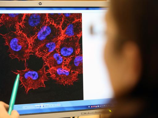 Im Labor des Instituts für Experimentelle Gentherapie und Tumorforschung (IEGT) der Universitätsmedizin Rostock schaut eine Doktorandin auf ein Monitorbild von Melanom-Zellen (schwarzer Hautkrebs). 