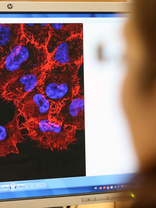 Im Labor des Instituts für Experimentelle Gentherapie und Tumorforschung (IEGT) der Universitätsmedizin Rostock schaut eine Doktorandin auf ein Monitorbild von Melanom-Zellen (schwarzer Hautkrebs). 