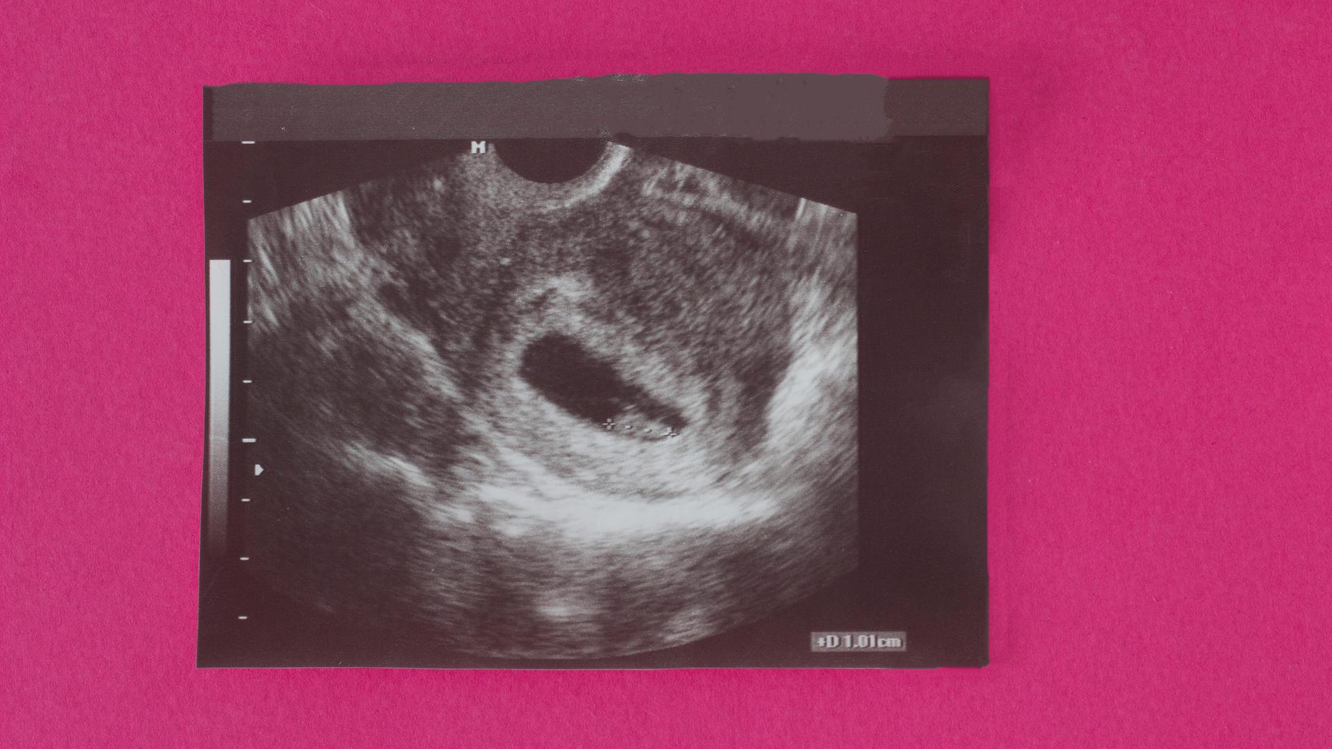 Ein Ultraschallbild einer sehr frühen Schwangerschaft, die Zellen sind 1cm gross.