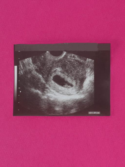 Ein Ultraschallbild ein sehr frühen Schwangerschaft, die Zellen sind 1cm gross.