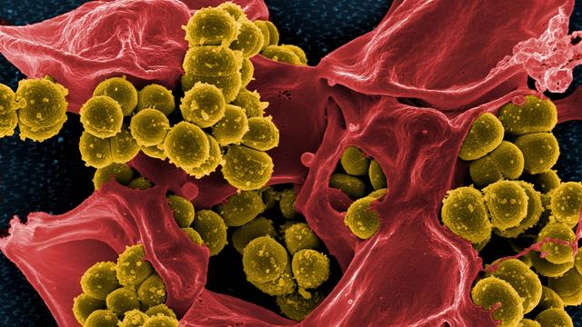 Farbig nachbearbeitete elektronenmikroskopische Aufnahme von methicillin-resistenten Staphylococcus-aureus-Bakterien (MRSA). Die kugelförmigen Bakterien sind gelb dargestellt. Daneben ist eine abgestorbene menschliche weiße Blutzelle in Rot zu sehen.