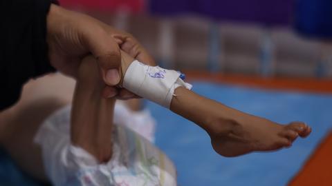 Das völlig abgemagerte Bein eines Kindes wird von medizinischem Personal untersucht.