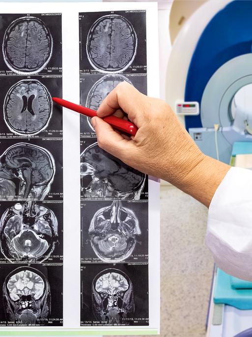 Arzt zeigt mit einemk Kugelschreiber auf ein MRT-Bild