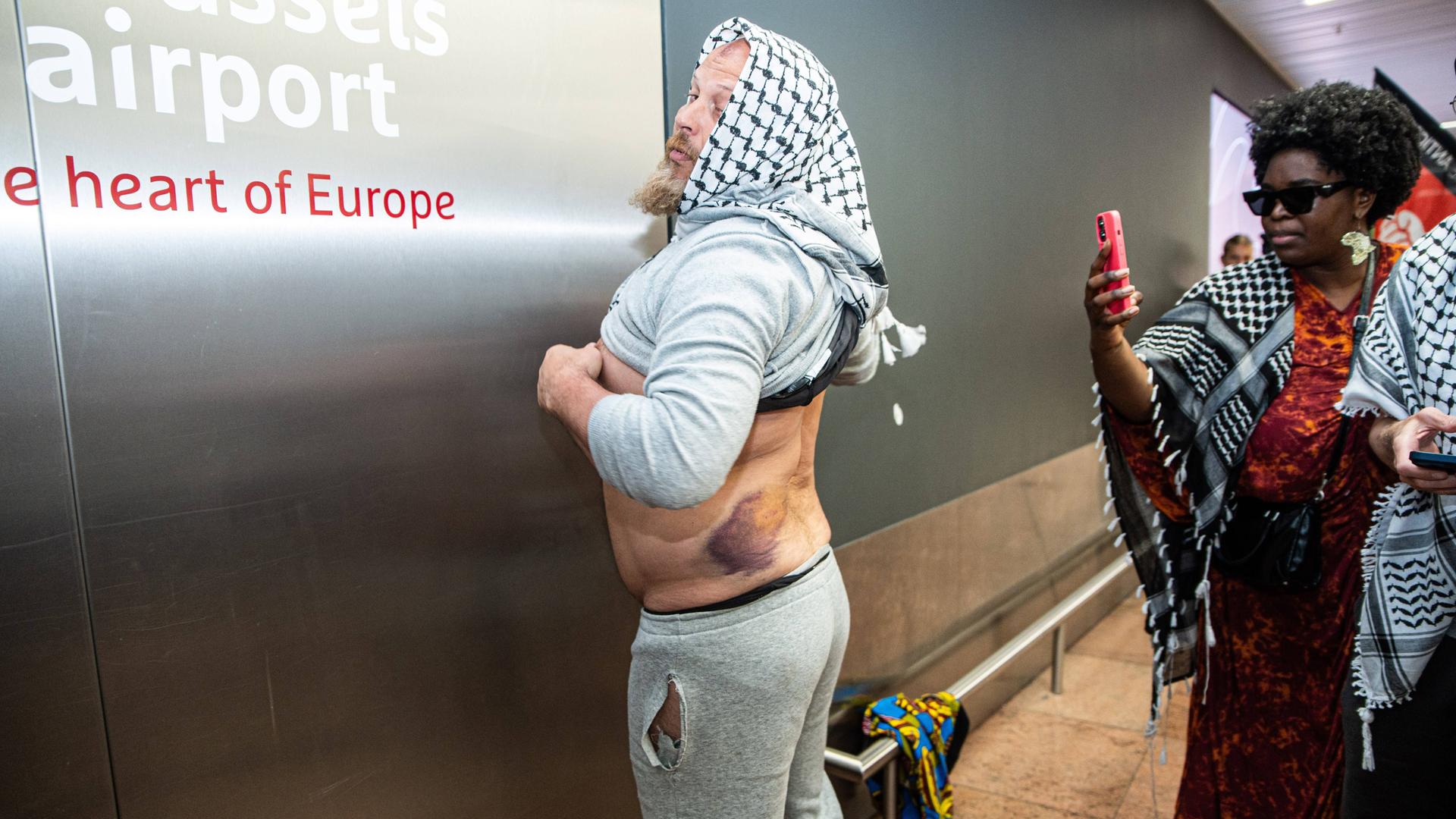 Ein Gaza-Aktivisten zeigt große Hämatome am Rücken. Ein Gaza-Aktivisten zeigt große Hämatome am Rücken.