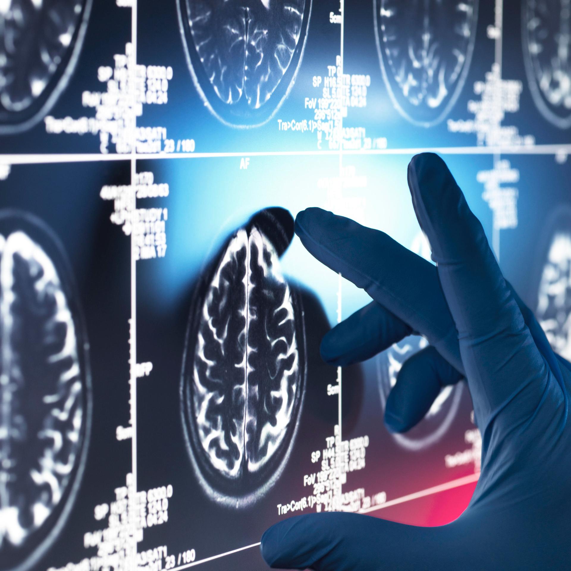 Leqembi Gegen Alzheimer   Wie Gut Ist Deutschland Auf Das Neue Medikament Vorbereitet? - f3xydp9