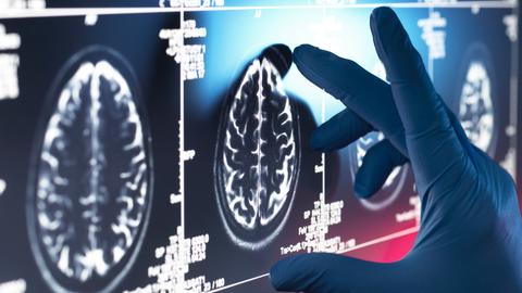 Eine Hand, die einen medizinischen Handschuh trägt, misst die Größe eines Gehirn, das auf einem CT-Scan zu sehen ist. 