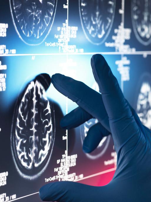 Eine Hand, die einen medizinischen Handschuh trägt, misst die Größe eines Gehirn, das auf einem CT-Scan zu sehen ist. 