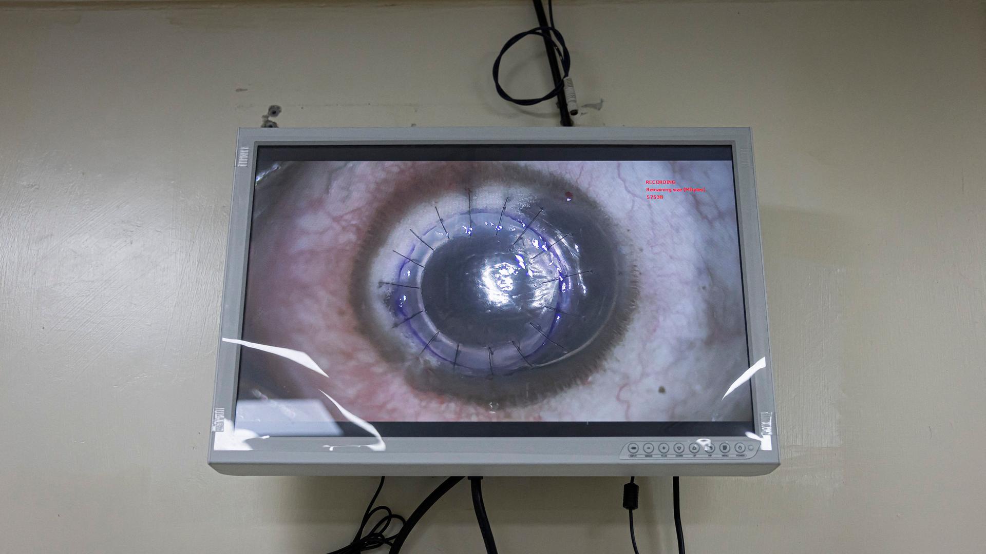 Ein Monitor hängt an einer Wand, auf der ein Auge zu sehen ist, das rund um die Iris genäht wurde.