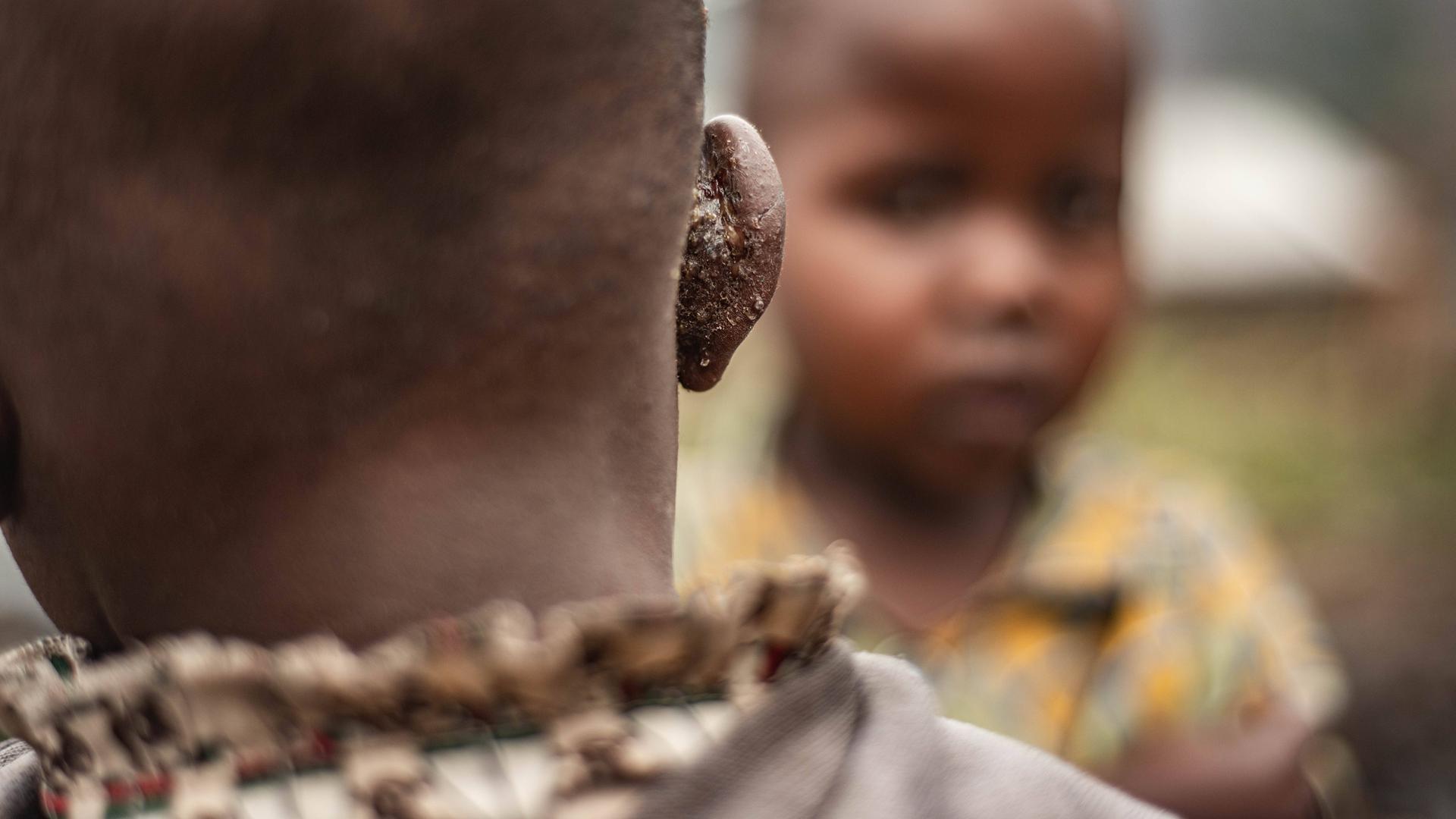 Großaufnahme eines Kinderkopfes von hinten. Das Kind hat am Ohr die für eine Mpox-Infektion typischen Pocken.