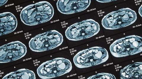 MRT-Untersuchung zur Diagnose von entzündlichen Erkrankungen des Darms