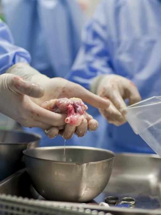 Ärzte halten ein Herz in den Händen im Operationssaal.