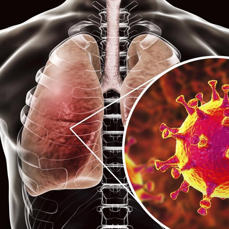 Konzeptionelle Darstellung einer Virusinfektion der Lunge mit einem MERS-Coronavirus 