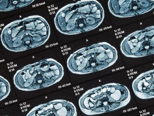 MRT-Untersuchung, Detail, MRT-Scan des Dünndarms, nichtinvasiver medizinischer Test zur Diagnose von Erkrankungen des Darms, wie Morbus Crohn, Großbritannien, Europa *** MRI examination detail MRI scan of the small intestine noninvasive medical test for the diagnosis of diseases of the intestine such as Crohns disease United Kingdom Europe Copyright: imageBROKER/SimonxBelcher ibxdig04739480.jpg Bitte beachten Sie die gesetzlichen Bestimmungen des deutschen Urheberrechtes hinsichtlich der Namensnennung des Fotografen im direkten Umfeld der Veröffentlichung!