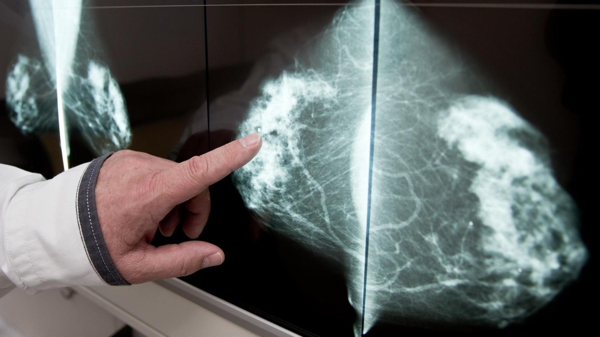 Ein Radiologe Gerhard Dilbat deutet auf einer Röntgen-Aufnahme einer Brust auf eine gutartige Fettzellen-Verkalkung