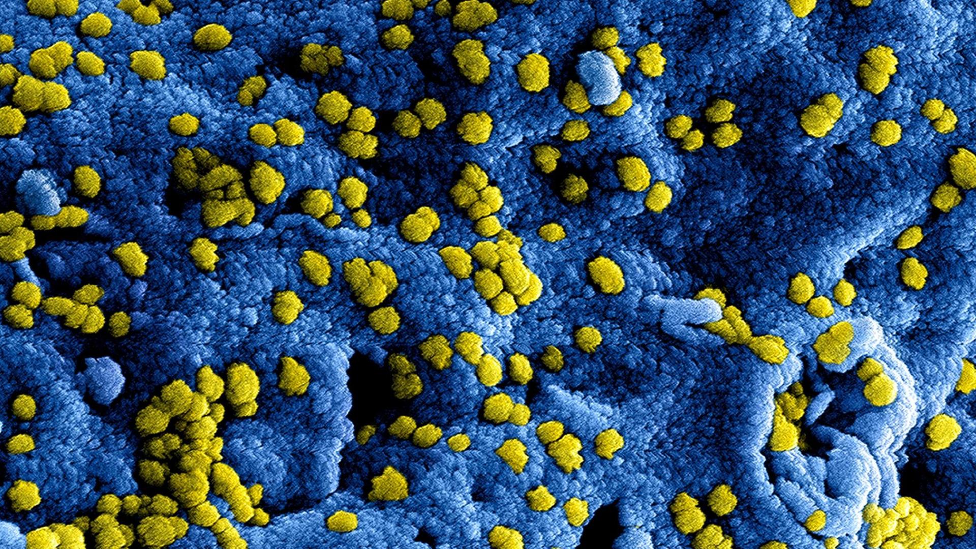 HANDOUT - Produced by the National Institute of Allergy and Infectious Diseases (NIAID), this highly-magnified, digitally-colorized scanning electron micrograph (SEM) reveals ultrastructural details at the site of interaction of numerous yellow-colored Middle East respiratory syndrome Coronavirus (MERS-CoV) viral particles that were on the surface of a Vero E6 cell, which had been colorized blue. MERS-CoV was identified in 2012 as the cause of respiratory illness in people. Investigations are being done to figure out the source of MERS-CoV and how it spreads. So far, there are no reports of anyone in the U.S. getting infected with MERS-CoV. Most people who got infected with MERS-CoV developed severe acute respiratory illness with symptoms of fever, cough, and shortness of breath. About half of them died. Some people were reported as having a mild respiratory illness. MERS-CoV has been shown to spread between people who are in close contact. Transmission from infected patients to healthcare personnel has also been observed. Clusters of cases in Saudi Arabia, Jordan, the UK, France, Tunisia, and Italy are being investigated. Photo: National Institute of Allergy and Infectious Diseases (NIAID) 2014/dpa (ACHTUNG: Nur zur redaktionellen Verwendung im Zusammenhang mit der aktuellen Berichterstattung und nur bei Nennung: "Foto: National Institute of Allergy and Infectious Diseases (NIAID) 2014/dpa"; zu: "Mann aus Region Osnabrück mit tödlichem Mers-Virus infiziert" vom