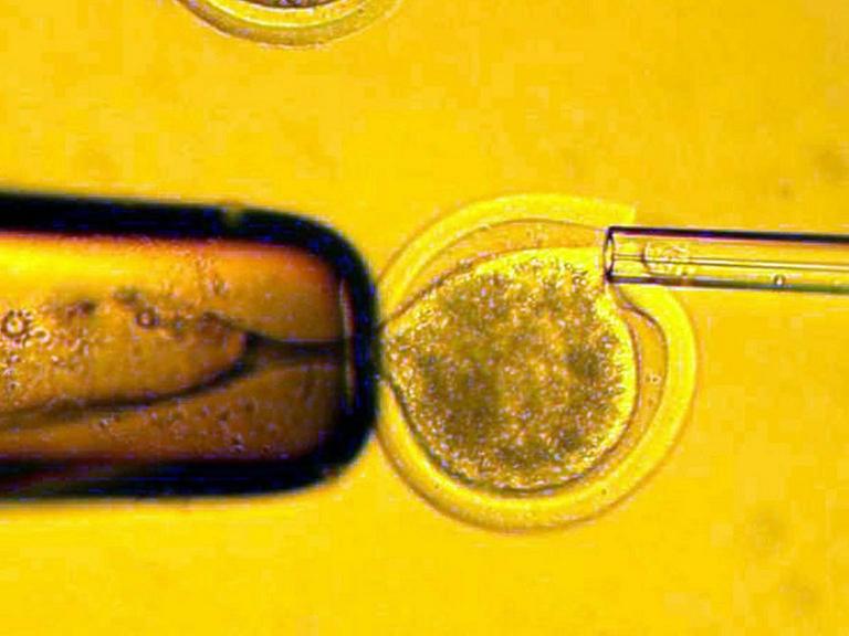 Übertragung der Körperzelle von einer Frau in eine entkernte Eizelle derselben Spenderin