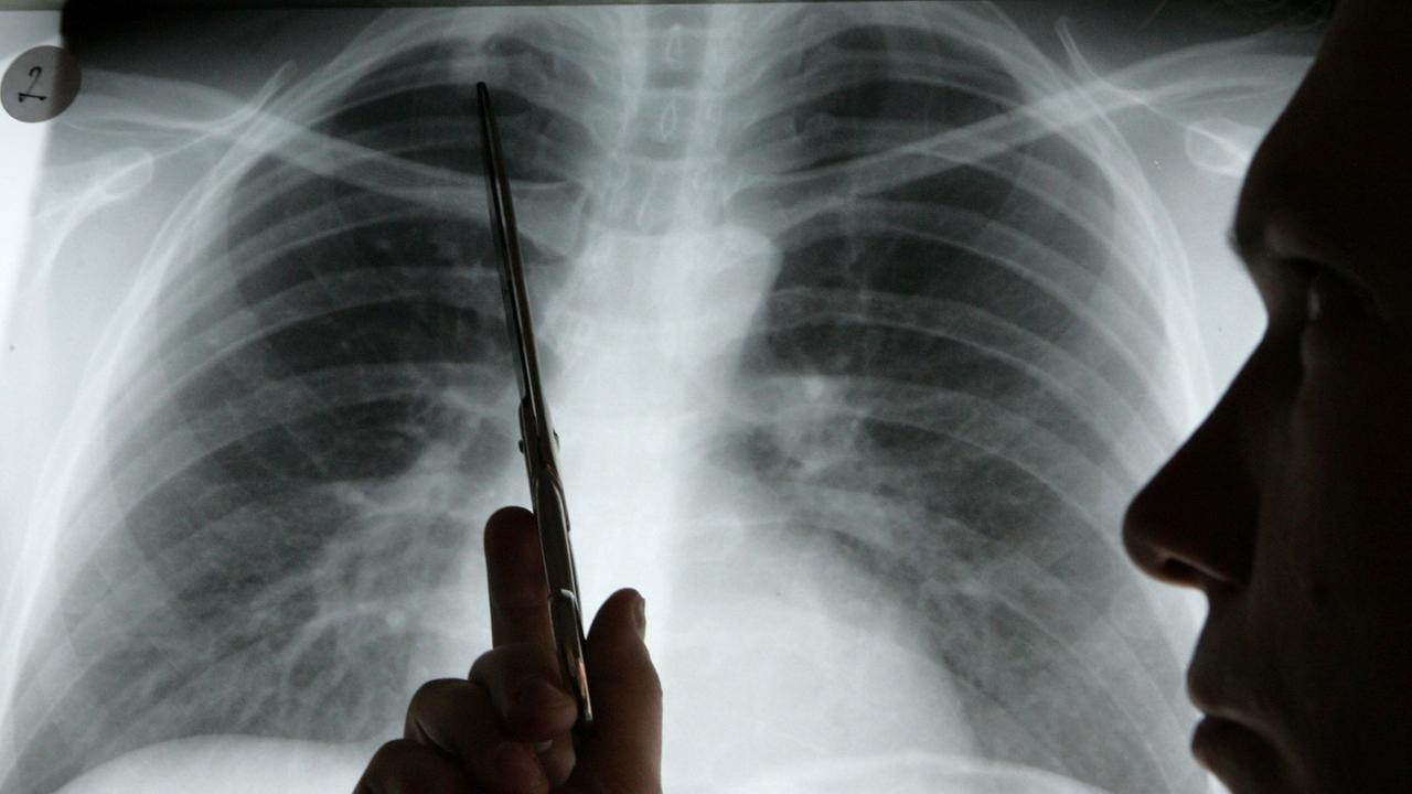 Diagnose Lungenkrebs: Ein Arzt zeigt auf einem Röntgenbild auf einen Tumor.