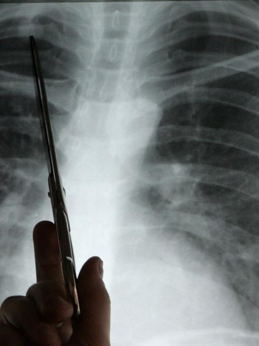 Diagnose Lungenkrebs: Ein Arzt zeigt auf einem Röntgenbild auf einen Tumor.