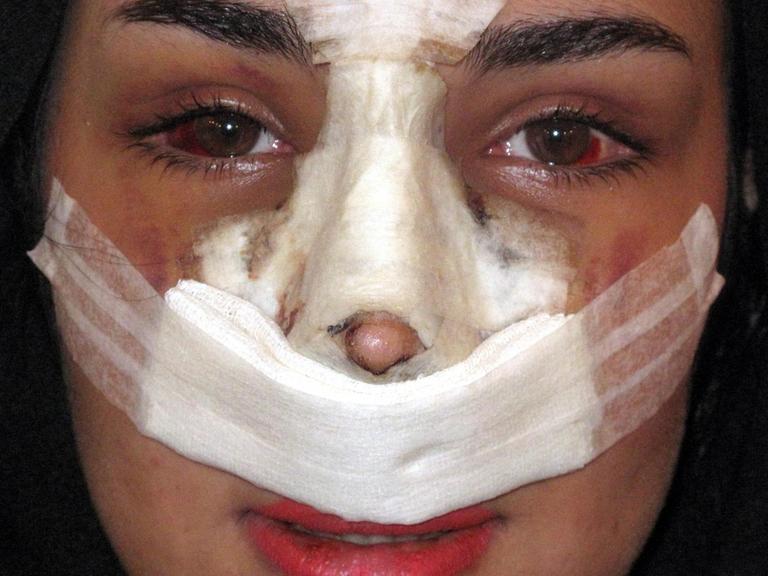 Eine iranische Frau präsentiert sich nach einer Schönheits-Operation im April 2014 in Teheran. Im Gottesstaat Iran müssen Frauen in der Öffentlichkeit Körper und Haare unter Kleidung und Schleier verbergen. Wer glaubt, dass deswegen Schönheits-Operationen keine Rolle spielen, irrt sich. Foto: Panthea Wassegh/dpa