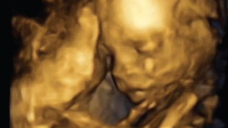 3D-Bild des Fötus auf einer Ultraschallaufnahme in der 18. Schwangerschaftswoche