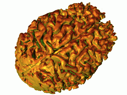 Dreidimensionale, aus MRT-Daten computergenerierte Aufsicht auf das Gehirn
