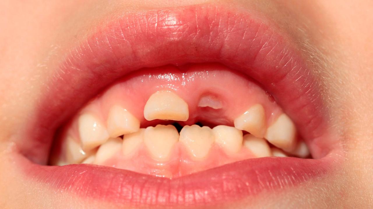 Eine Zahnlücke mit einem nachwachsenden Zahn.