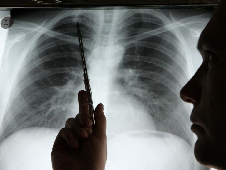 Diagnose Lungenkrebs: Ein Arzt zeigt auf einem Röntgenbild auf einen Tumor.