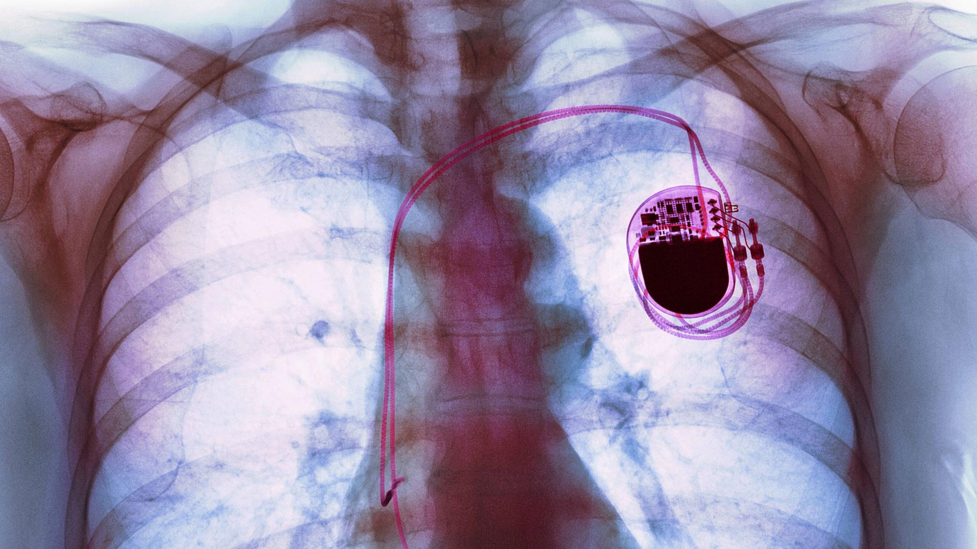 Röntgenaufnahme eines Patienten mit einem Herzschrittmacher